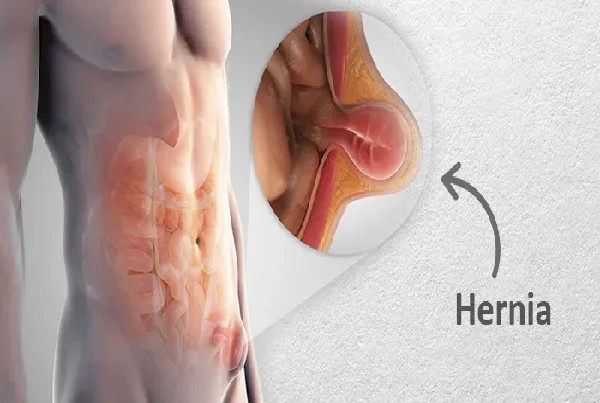 Hernia Surgery