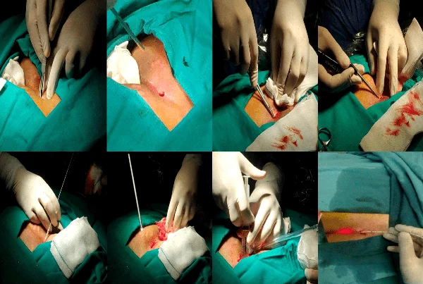 Pilonidal sinus surgery