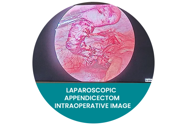 Laparoscopic Appendicectomy