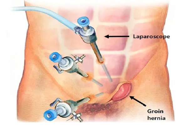 Laparoscopic hernia repair