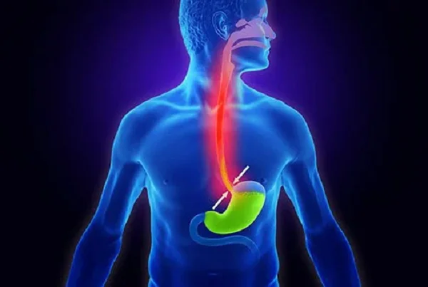 Laparoscopic Fundoplication