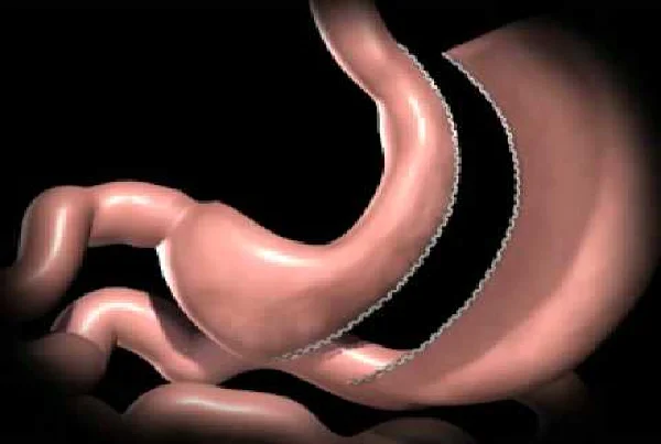 Laparoscopic Sleeve Gastrectomy