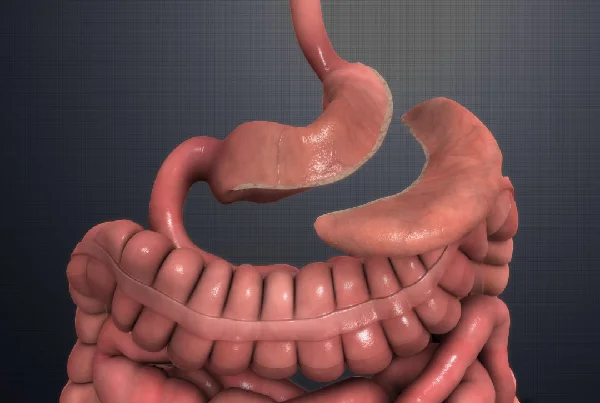Laparoscopic RouxenY Gastric bypass