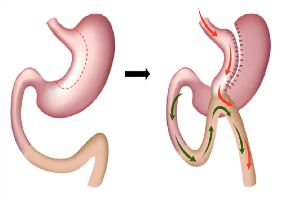Laparoscopic Mini Gastric bypass