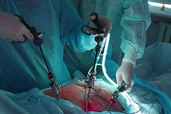 Laparoscopic GallBladder Surgery