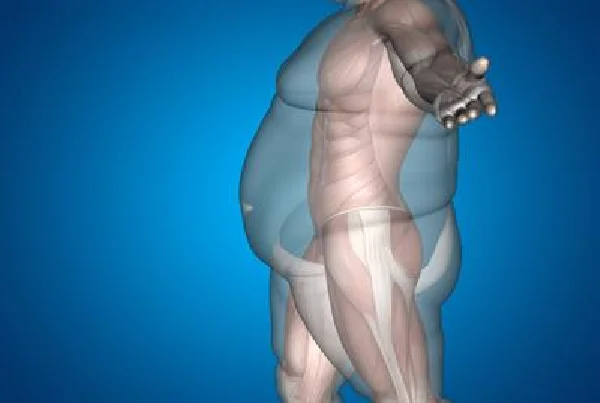 Bariatric Surgery